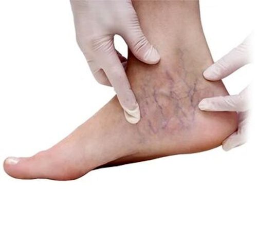 این علائم در پا یعنی واریس دارید